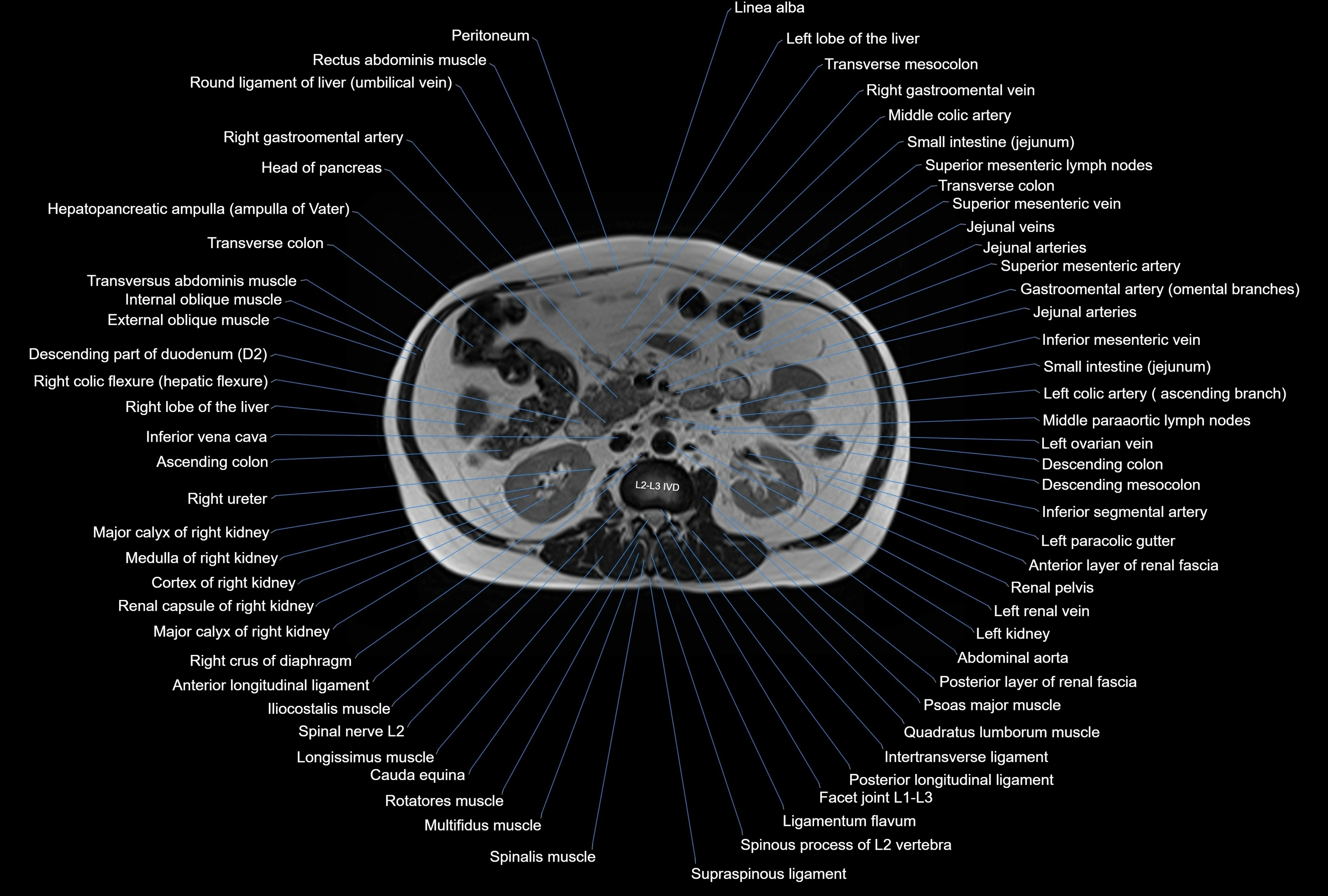 MRI Abdomen axial cross sectional anatomy radiology  image-img-00001-00023.webp